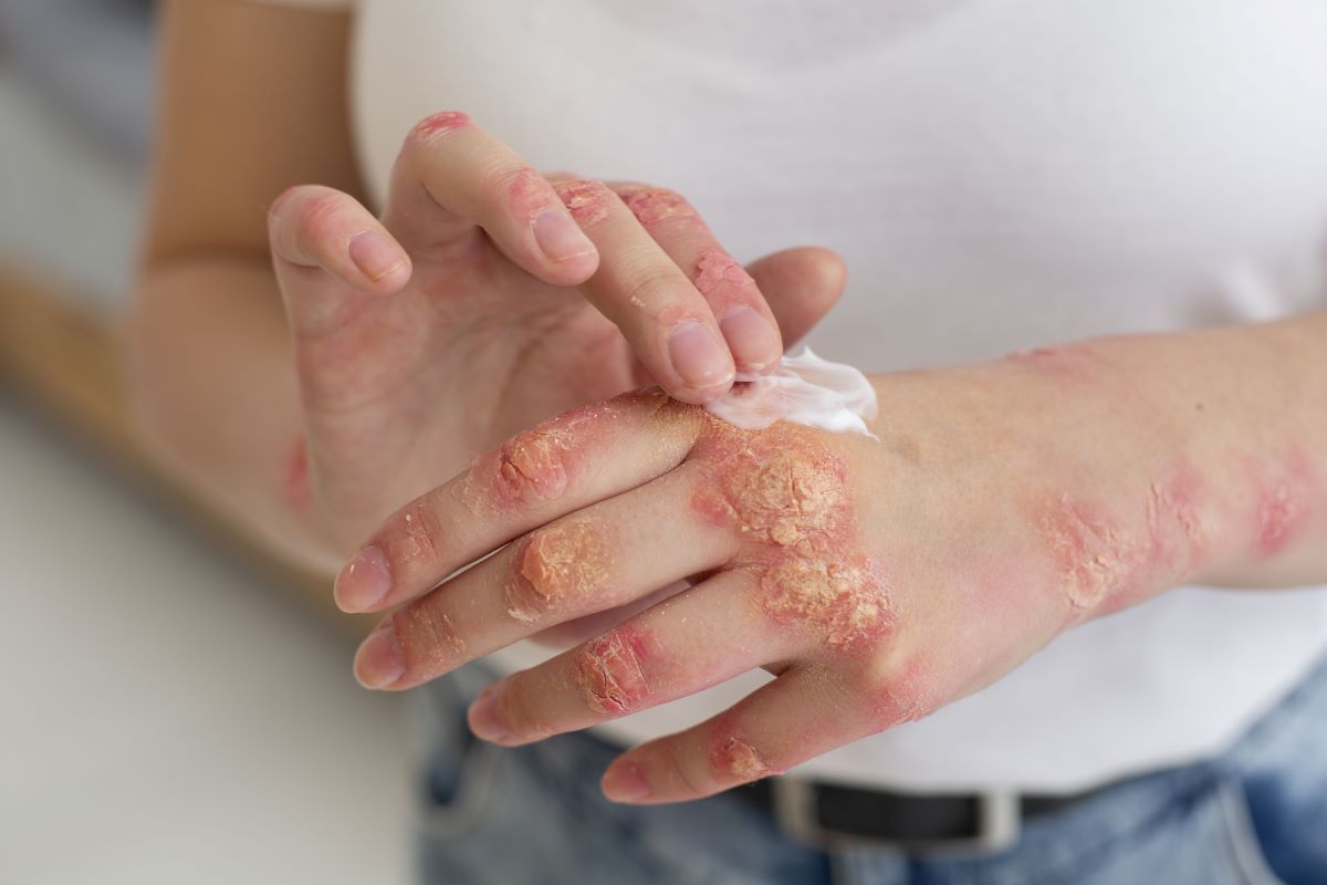 psoriáza lupénka na rukou